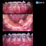 Damon 2.0. How to treat all common malocclusions