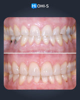 Tooth Wear Management: Italian School Protocols