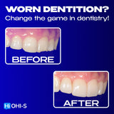 The Index Technique. No-prep worn dentition treatment