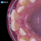 Damon 2.0. How to treat all common malocclusions