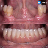 All‑Digital Workflow: Protocols for Flawless Indirect Restorations