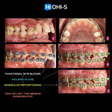 Biomechanics in Orthodontics