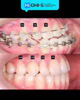 Damon 2.0. How to treat all common malocclusions