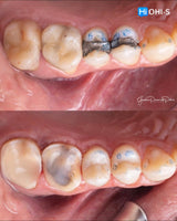 The Biomimetic Concept: Composite Restoration Protocols