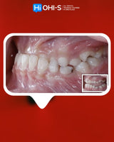 Orthodontics for Children and Teenagers