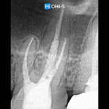 What’s NEW in Endodontics: From Anesthesia to Obturation