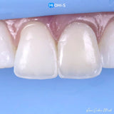 The Biomimetic Concept: Composite Restoration Protocols
