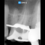 What’s NEW in Endodontics: From Anesthesia to Obturation