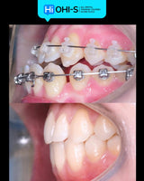 Damon 2.0. How to treat all common malocclusions