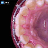 Damon 2.0. How to treat all common malocclusions