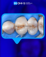 The Biomimetic Concept: Composite Restoration Protocols
