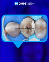 The Biomimetic Concept: Composite Restoration Protocols