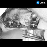 Predictable Sinus Lift