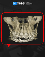 Apical Surgery: For Endodontists and Surgeons