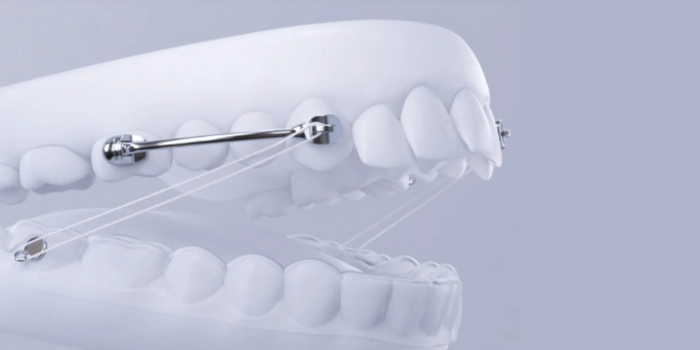 The Sagittal First concept: Treatment of Most Common Malocclusions