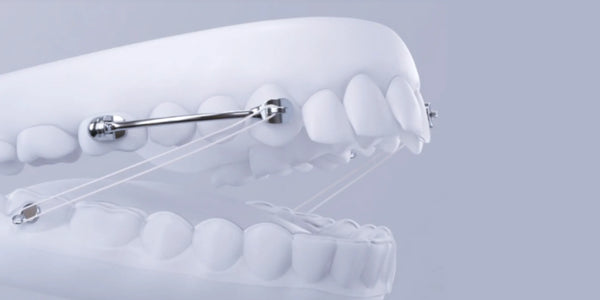 The Sagittal First concept: Treatment of Most Common Malocclusions