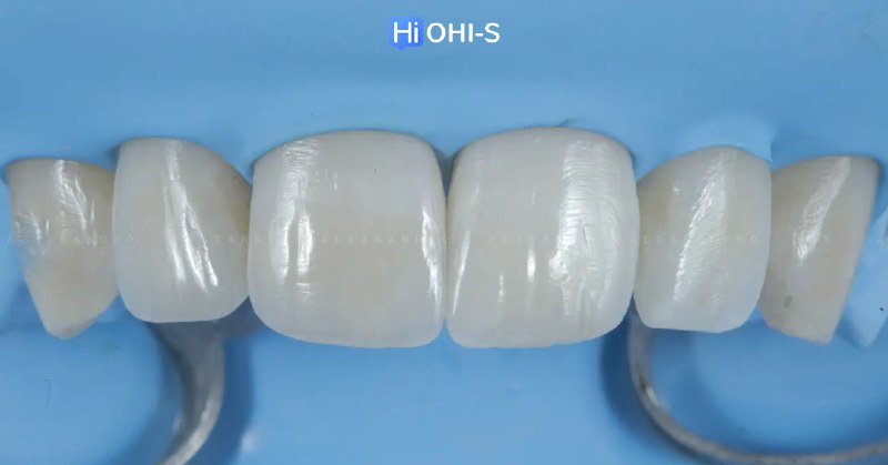 International Schools Working with Composite Restorations