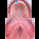 Bone Augmentation: Current Techniques