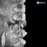 Damon 2.0. How to treat all common malocclusions
