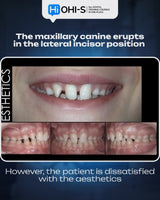 Missing Maxillary Lateral Incisors: Space Closure in All Malocclusions vs. Implants and Prosthetic Replacement