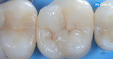 International Schools Working with Composite Restorations