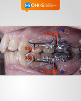 Biomechanics in Orthodontics