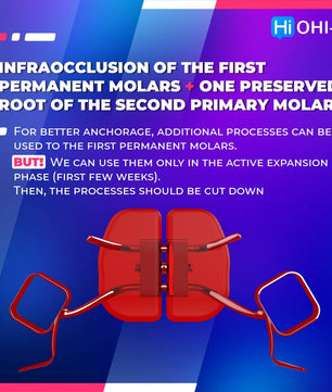 Early Orthodontic Treatment: When and How? - Dental Courses | كورسات طب اسنان