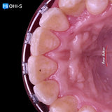 Damon 2.0. How to treat all common malocclusions