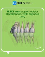 Aligners and Microimplants: Combined Protocol