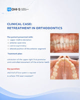 Biomechanics in Orthodontics