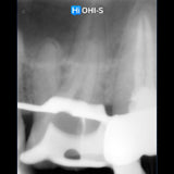 What’s NEW in Endodontics: From Anesthesia to Obturation