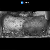 Bone Augmentation: Current Techniques