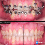 Damon 2.0. How to treat all common malocclusions