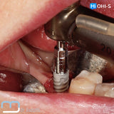 Predictable Sinus Lift