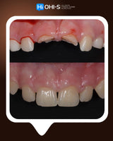 Dental Trauma Without Drama