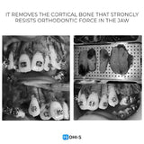 Accelerated Orthodontics: Baruti‑Demiraqi Corticotomy Protocol