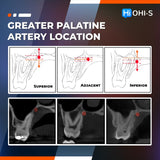 Apical Surgery: For Endodontists and Surgeons