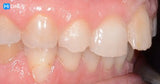 The Index Technique. No-prep worn dentition treatment