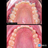 Damon 2.0. How to treat all common malocclusions