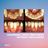 Early Orthodontic Treatment: When and How?