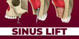 Predictable Sinus Lift