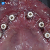 Removable dentures for dentists and technicians