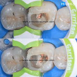Indirect Restoration in the Biomimetic Concept