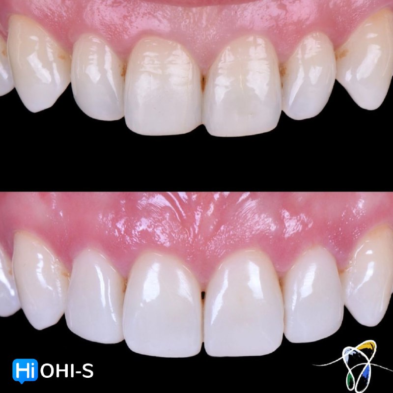 Composite Veneers, All Restorative Techniques