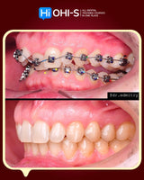 Damon 2.0. How to treat all common malocclusions