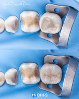 The Biomimetic Concept: Composite Restoration Protocols