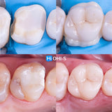All‑Digital Workflow: Protocols for Flawless Indirect Restorations