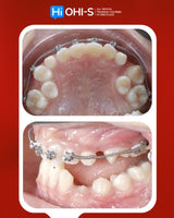 Orthodontics for Children and Teenagers