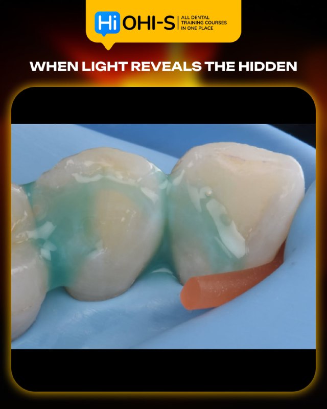 International Schools Working with Composite Restorations