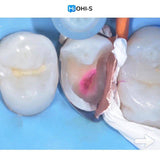 The Biomimetic Concept: Composite Restoration Protocols
